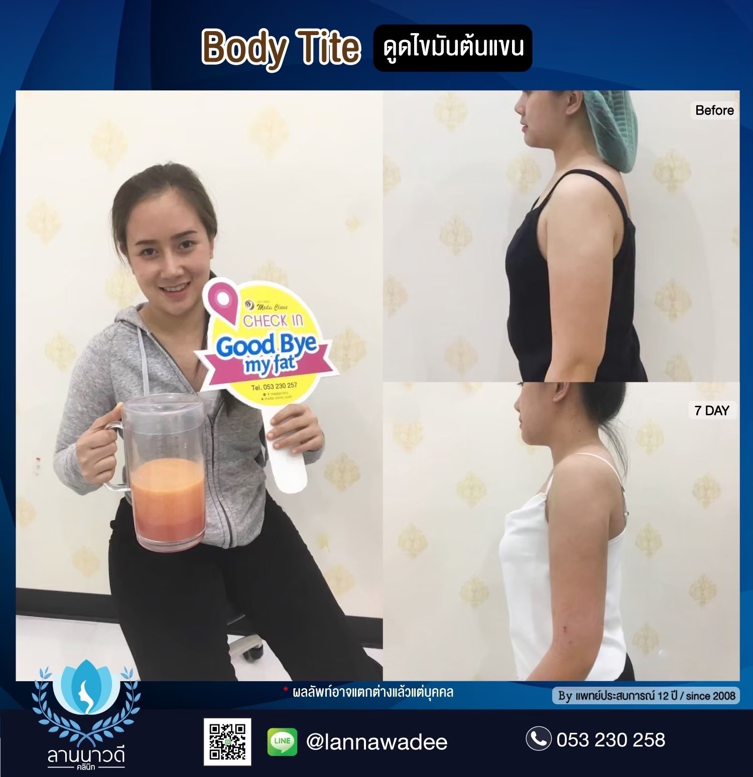 Arm liposuction Chiang Mai