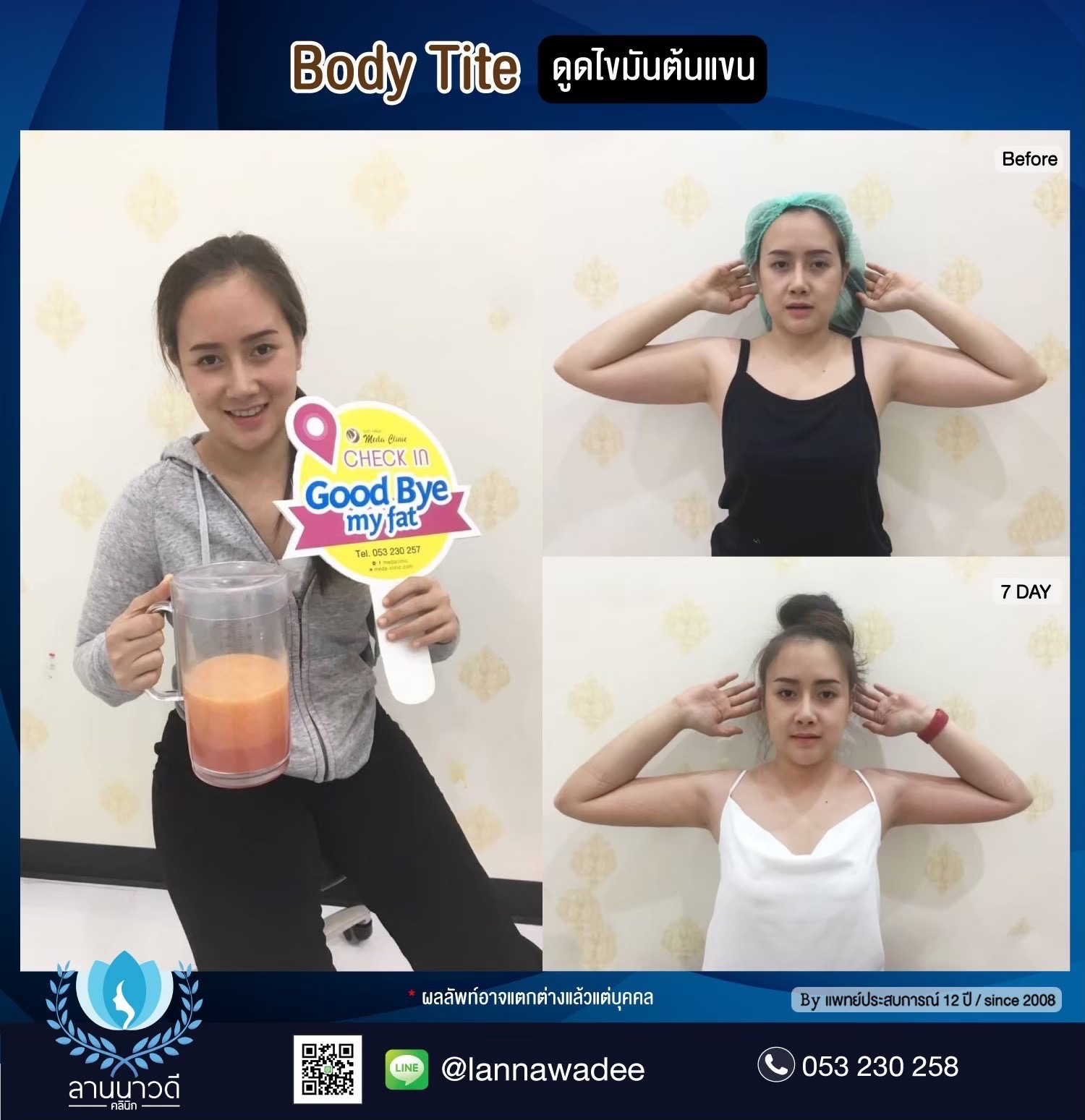 Arm liposuction Chiang Mai