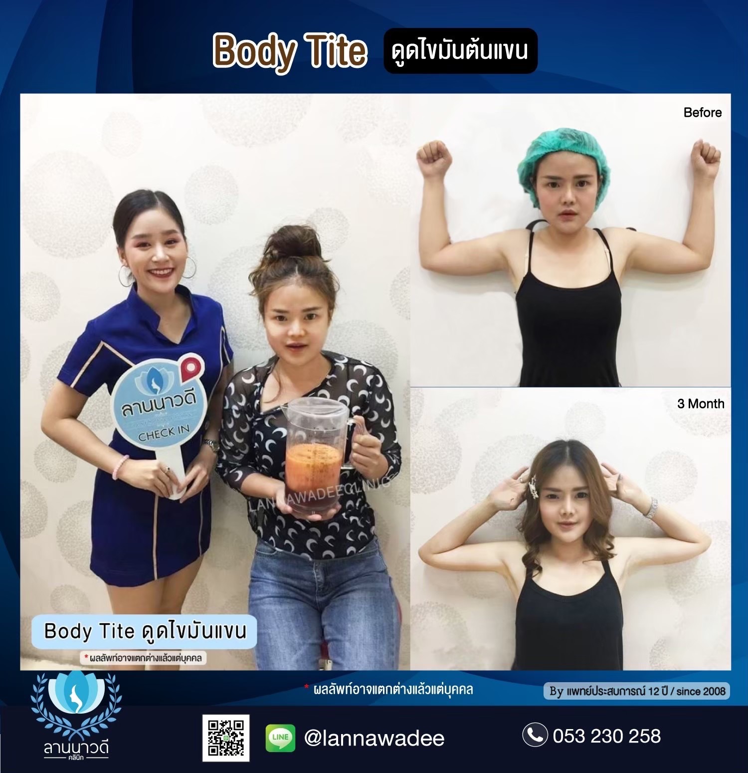 Arm liposuction Chiang Mai