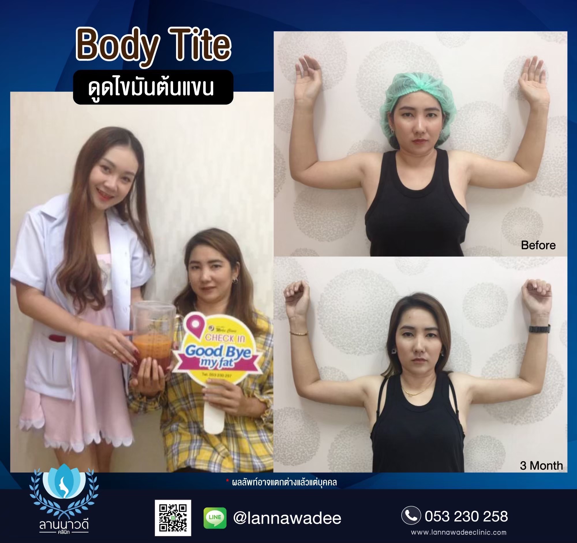 Arm liposuction Chiang Mai