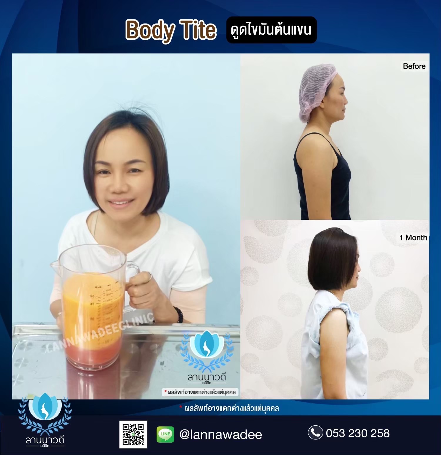 Arm liposuction Chiang Mai