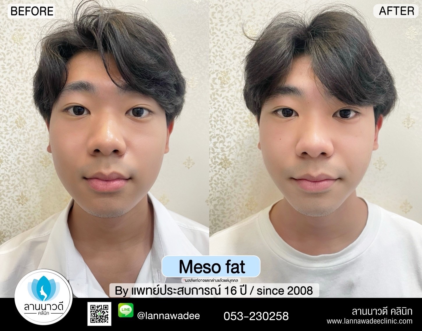รักษาฝ้ากระเชียงใหม่