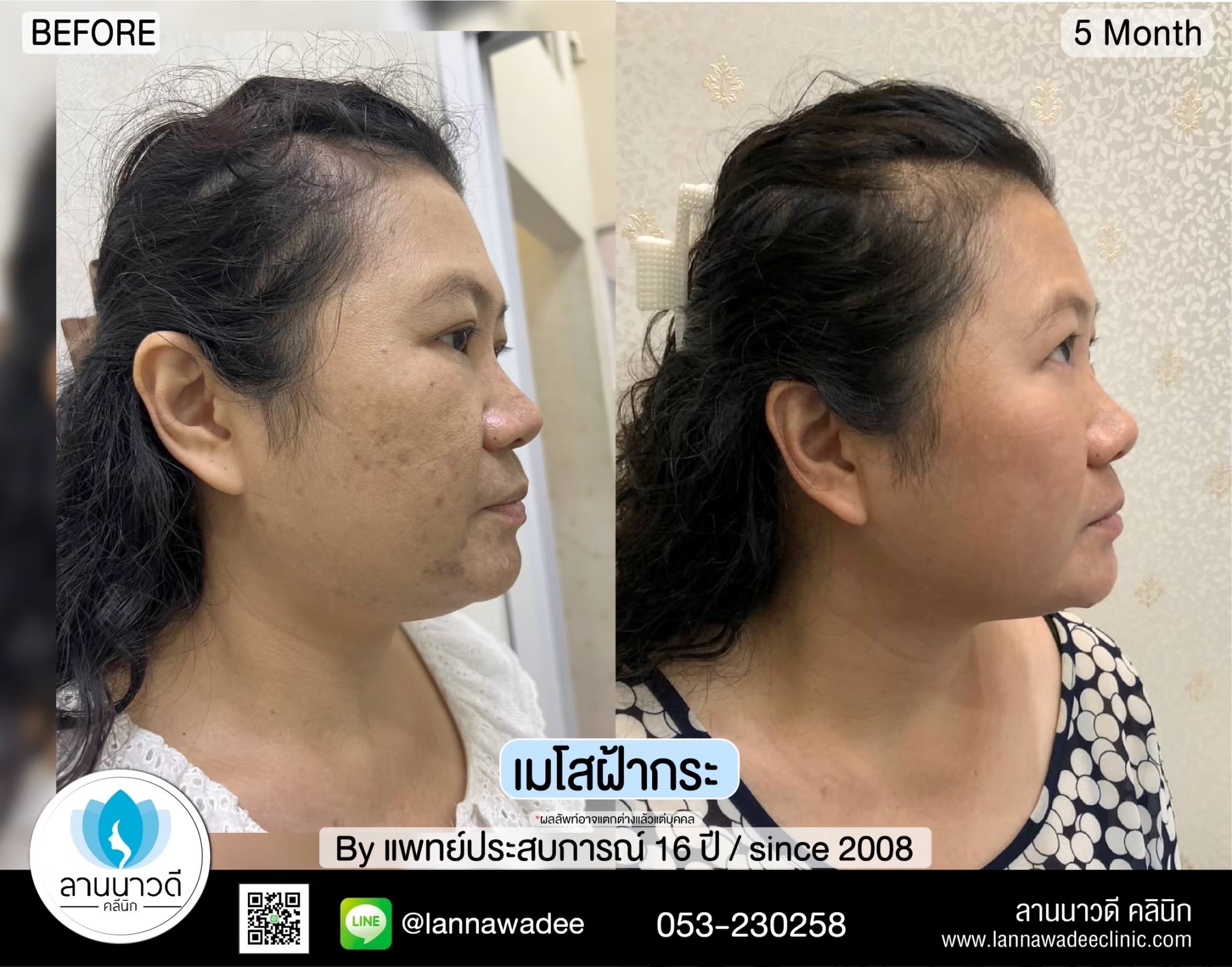 รักษาฝ้ากระเชียงใหม่