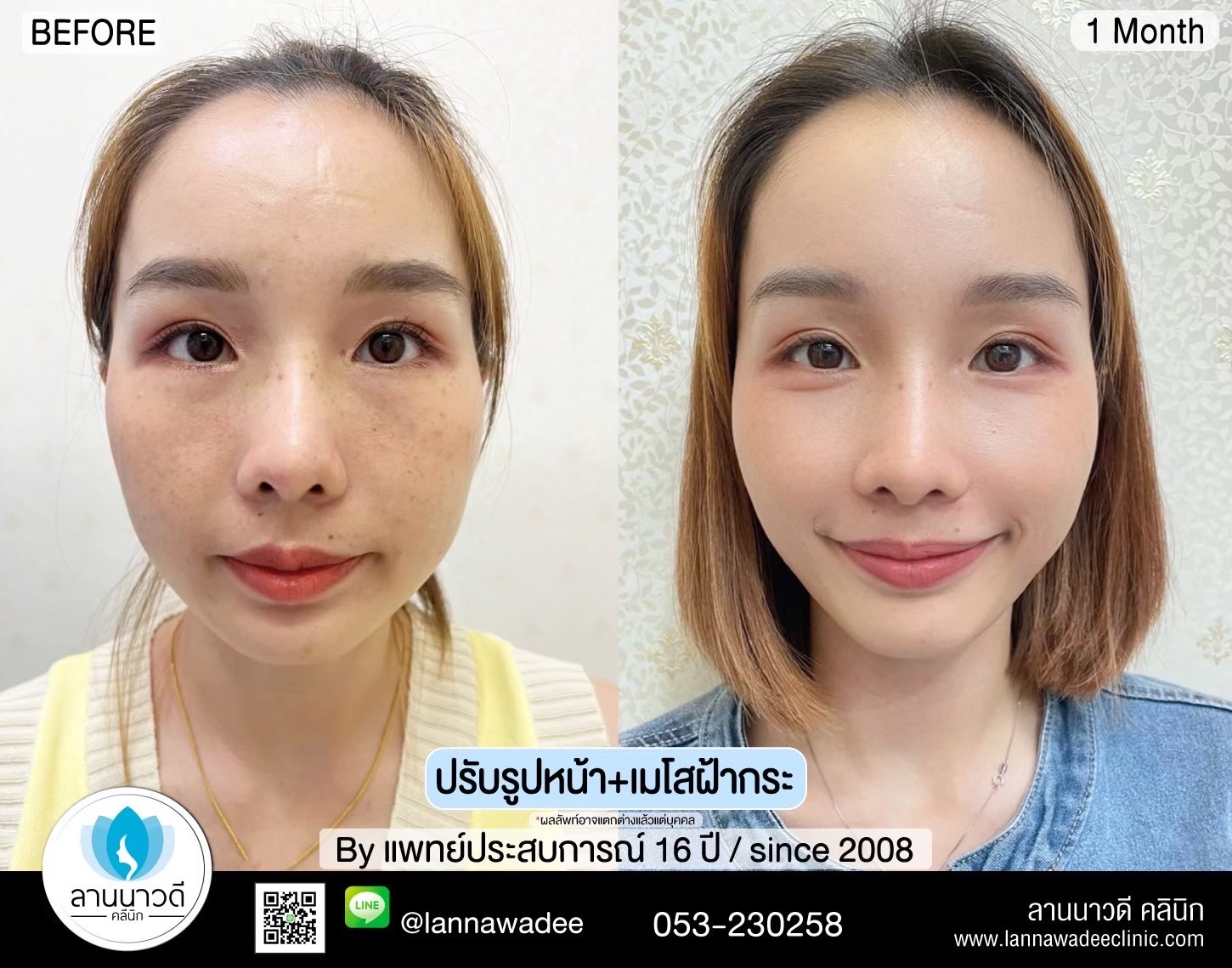 รักษาฝ้ากระเชียงใหม่