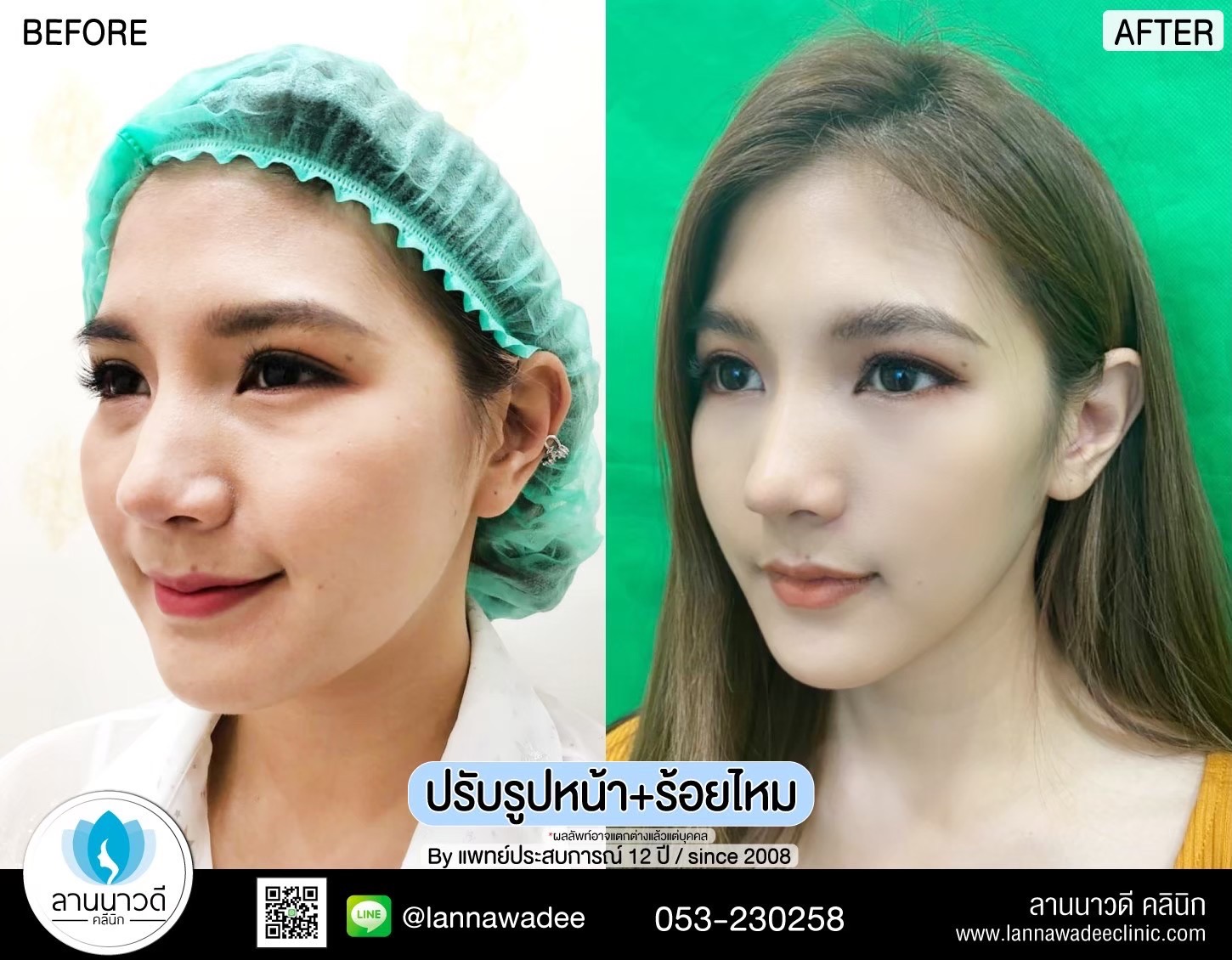 รักษาฝ้ากระเชียงใหม่