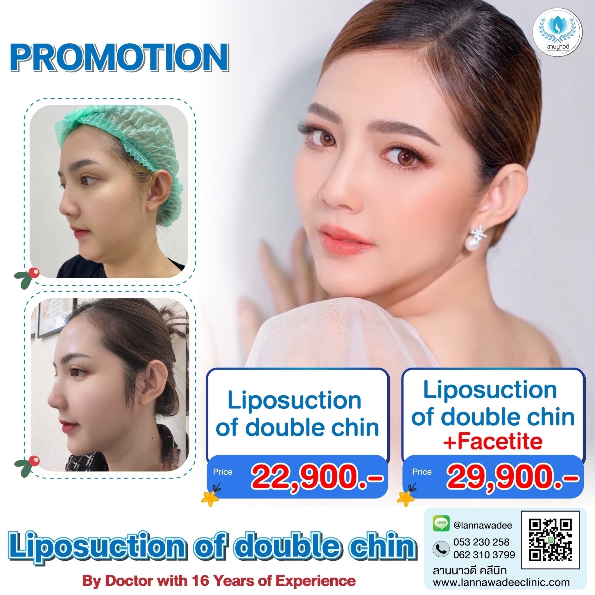 Liposuction of double chin Chiang Mai