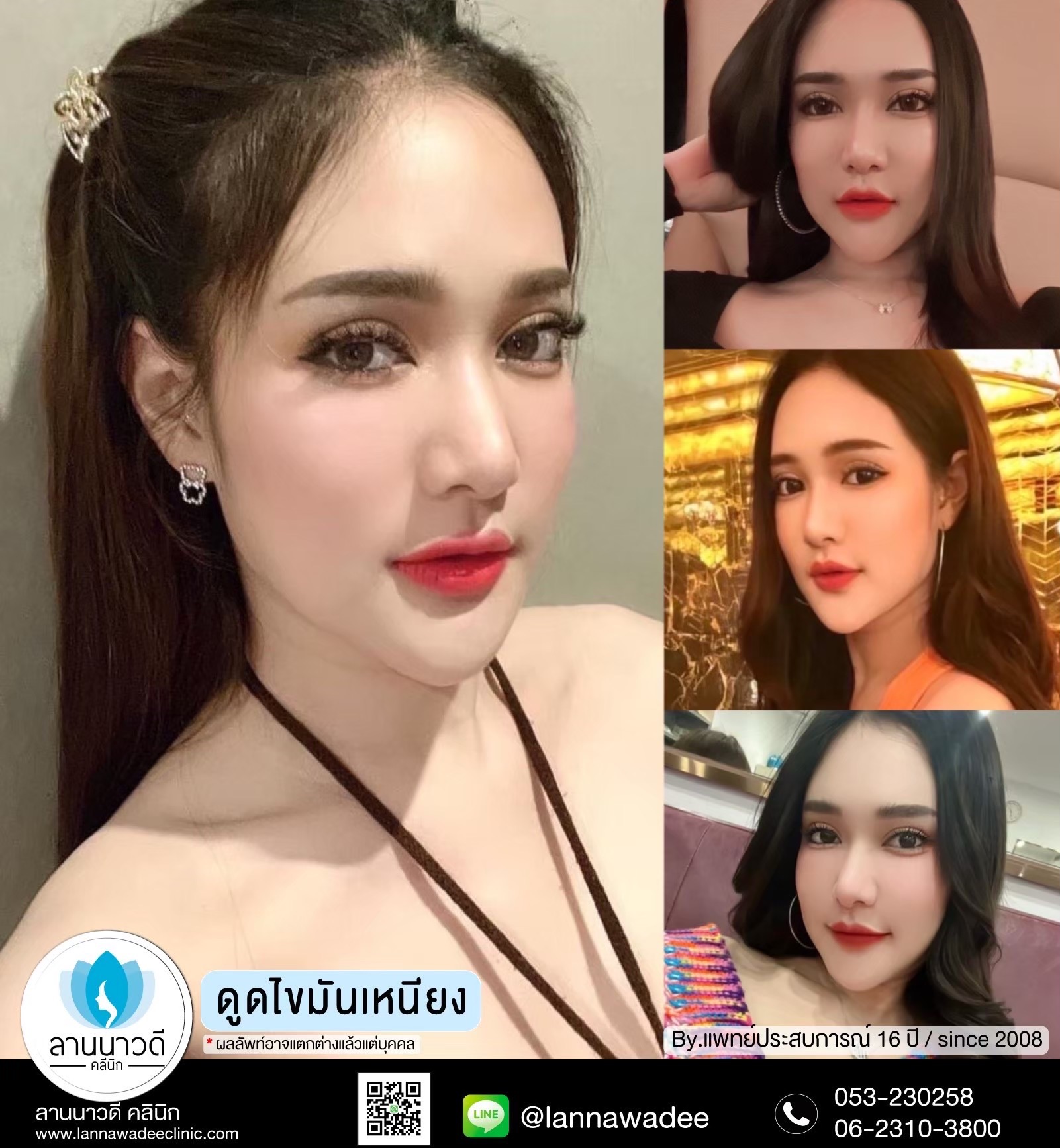 Liposuction of double chin Chiang Mai