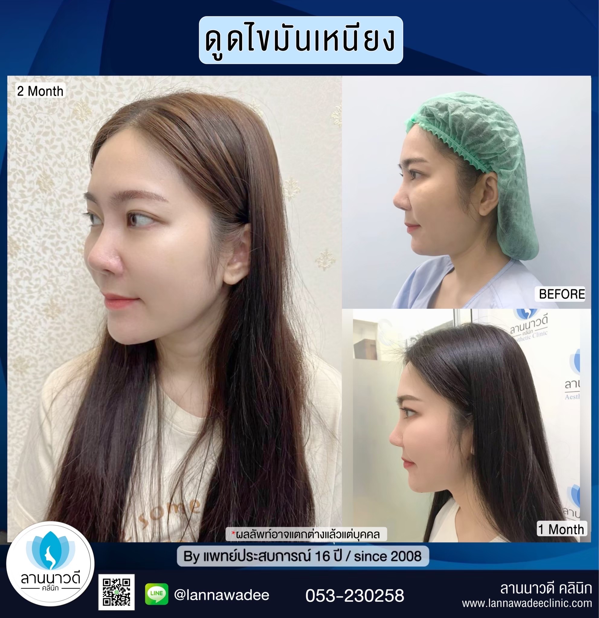 Liposuction of double chin Chiang Mai