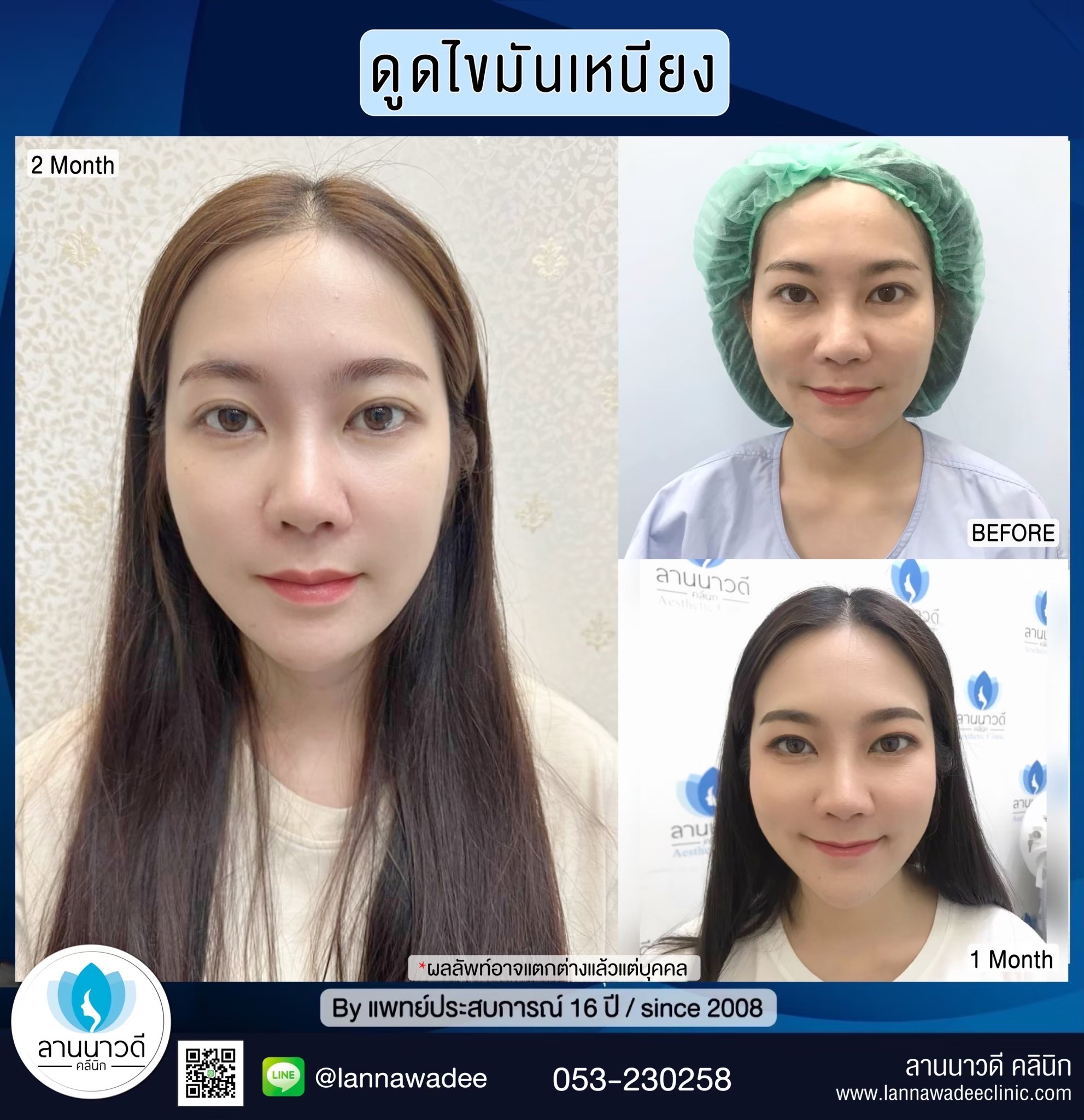 Liposuction of double chin Chiang Mai