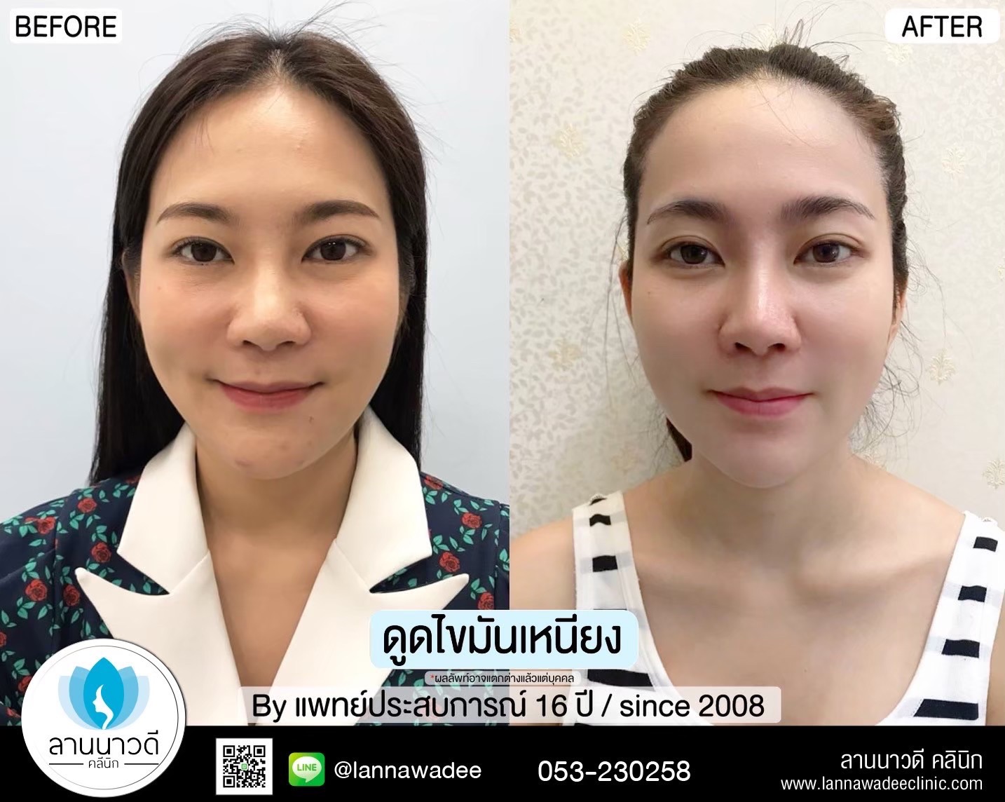 Liposuction of double chin Chiang Mai