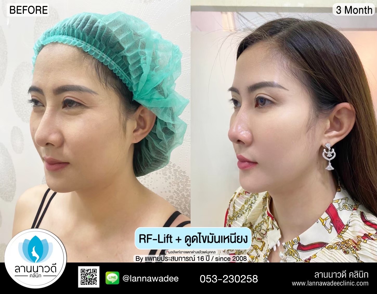 Liposuction of double chin Chiang Mai