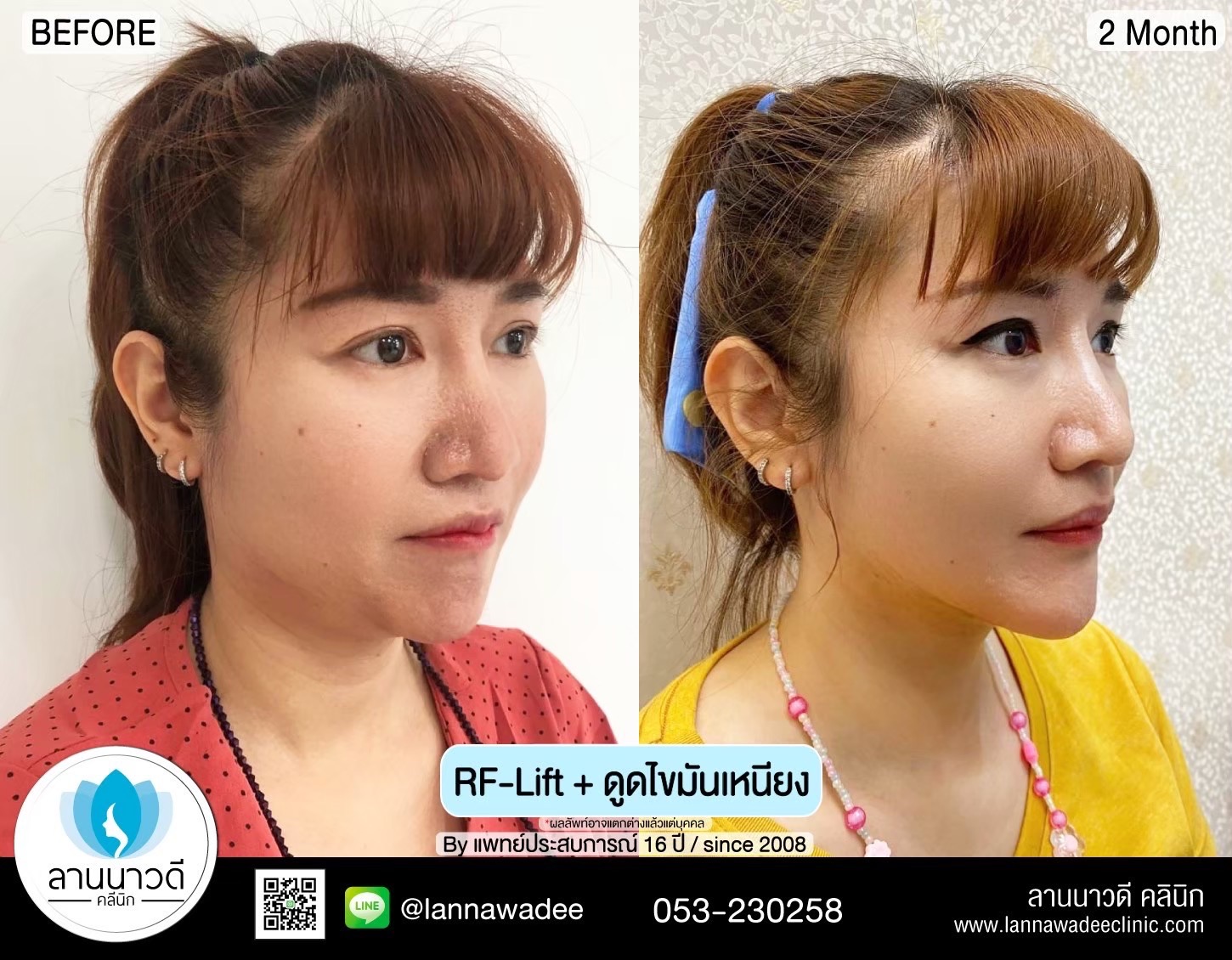 Liposuction of double chin Chiang Mai