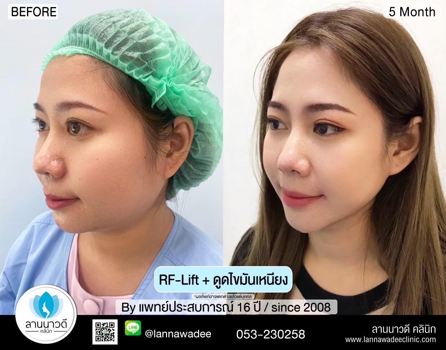 Liposuction of double chin Chiang Mai