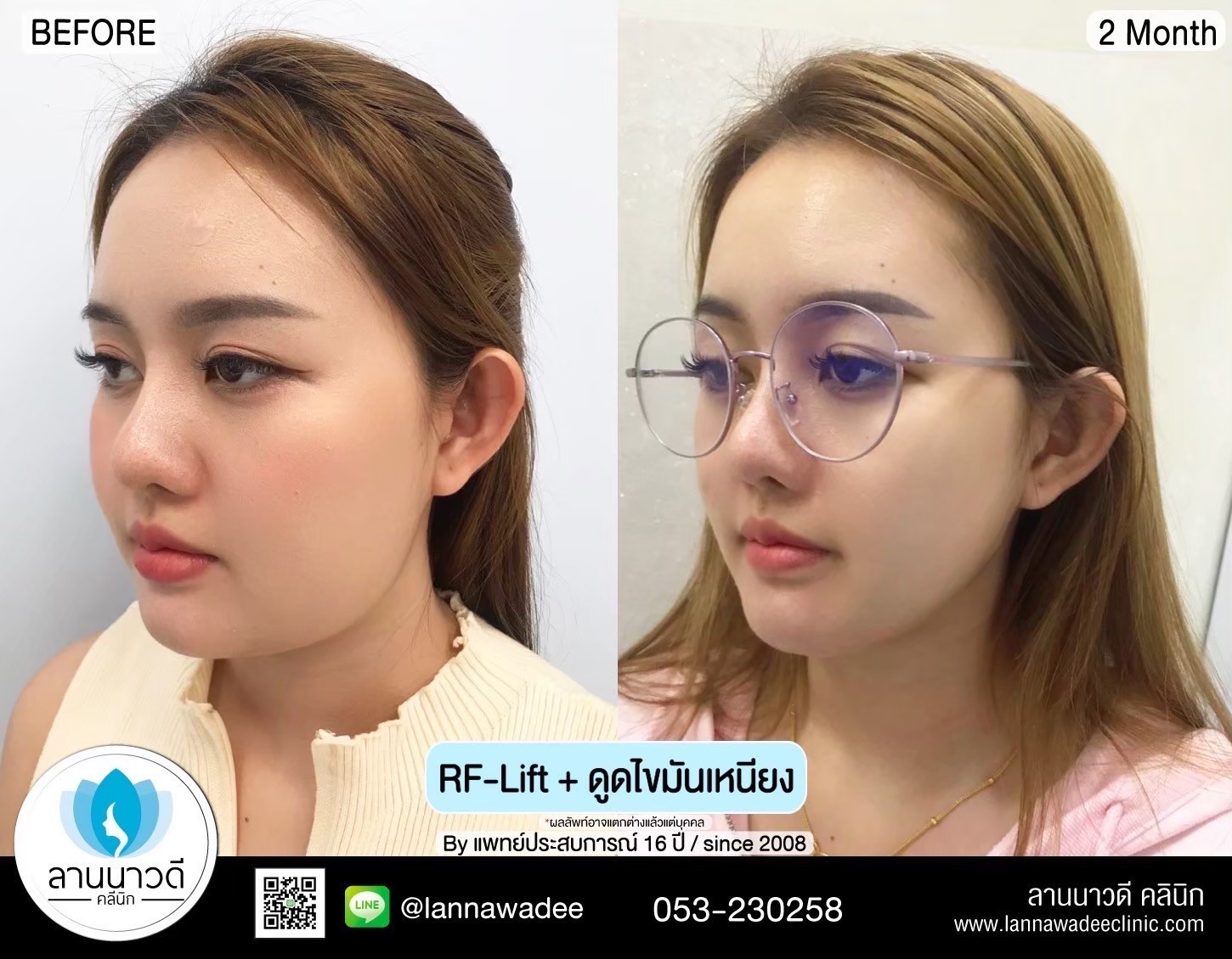 Liposuction of double chin Chiang Mai