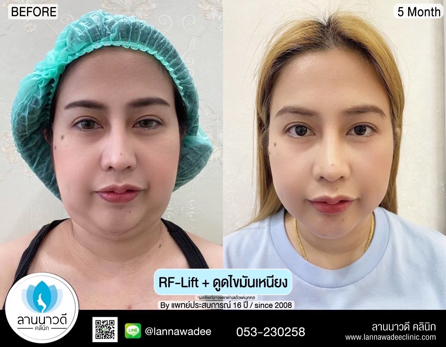 Liposuction of double chin Chiang Mai