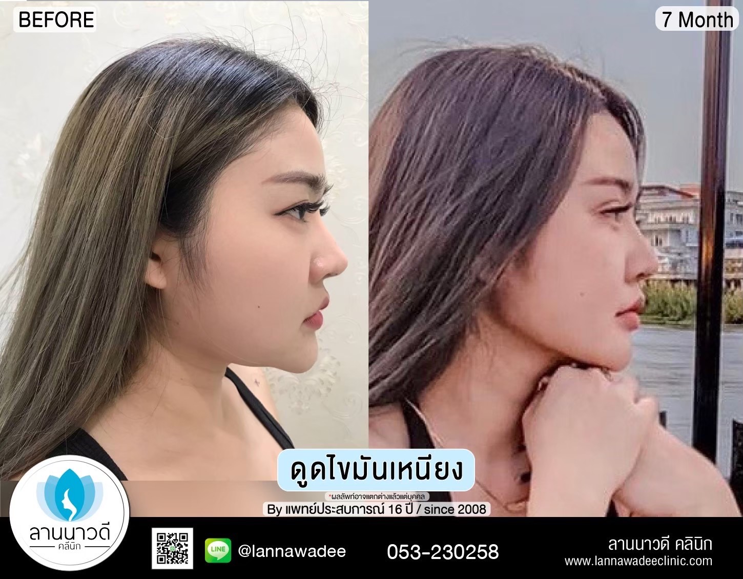 Liposuction of double chin Chiang Mai