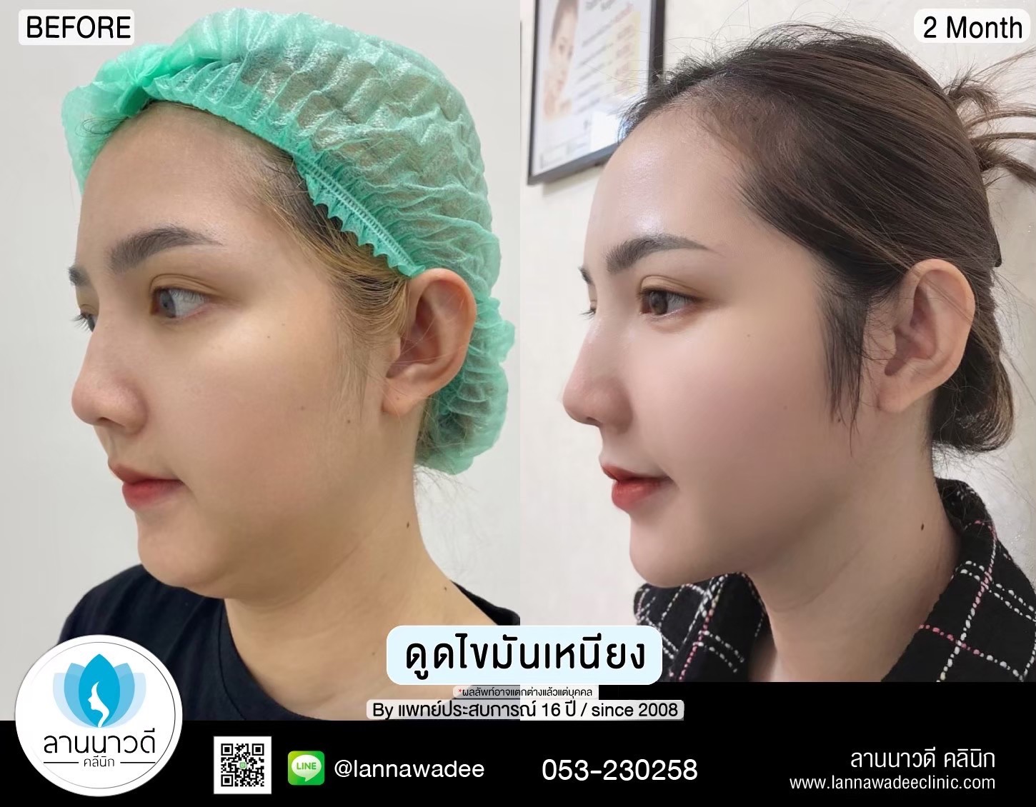 Liposuction of double chin Chiang Mai