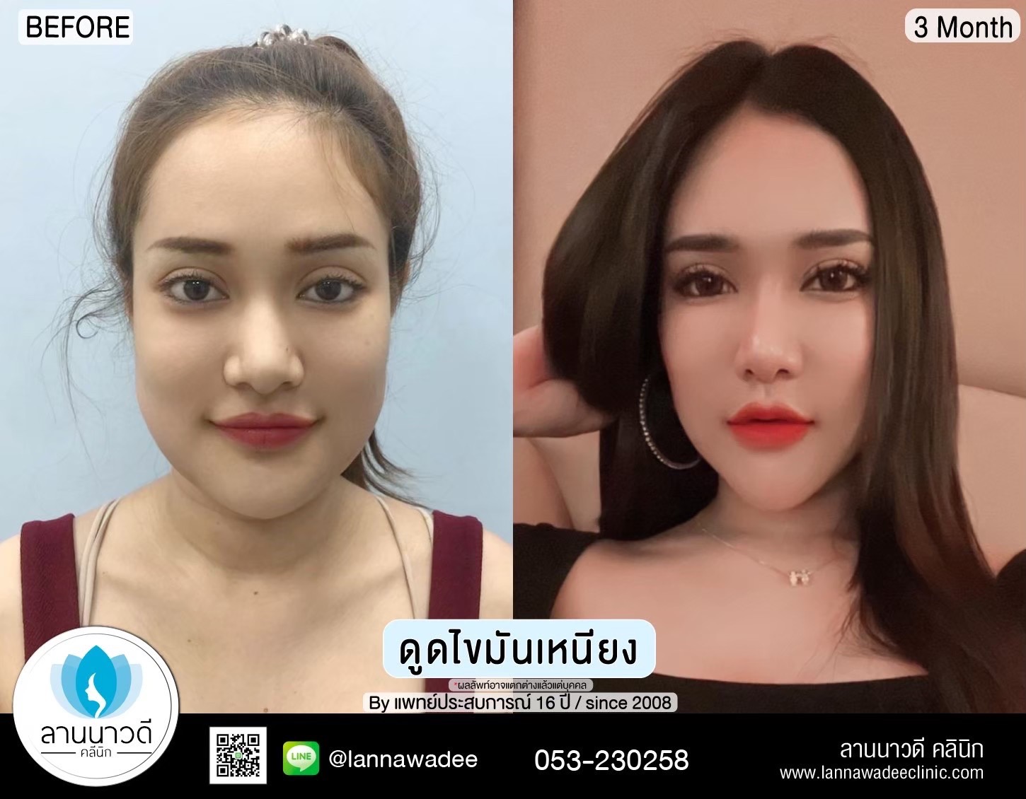 Liposuction of double chin Chiang Mai