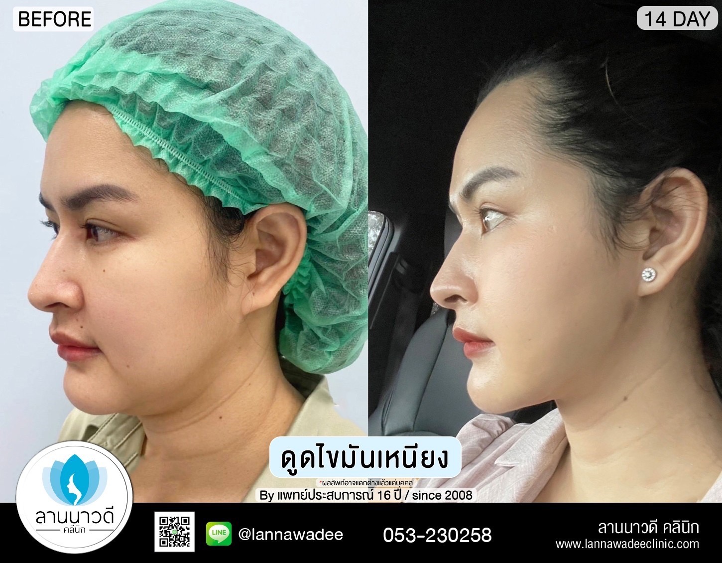 Liposuction of double chin Chiang Mai