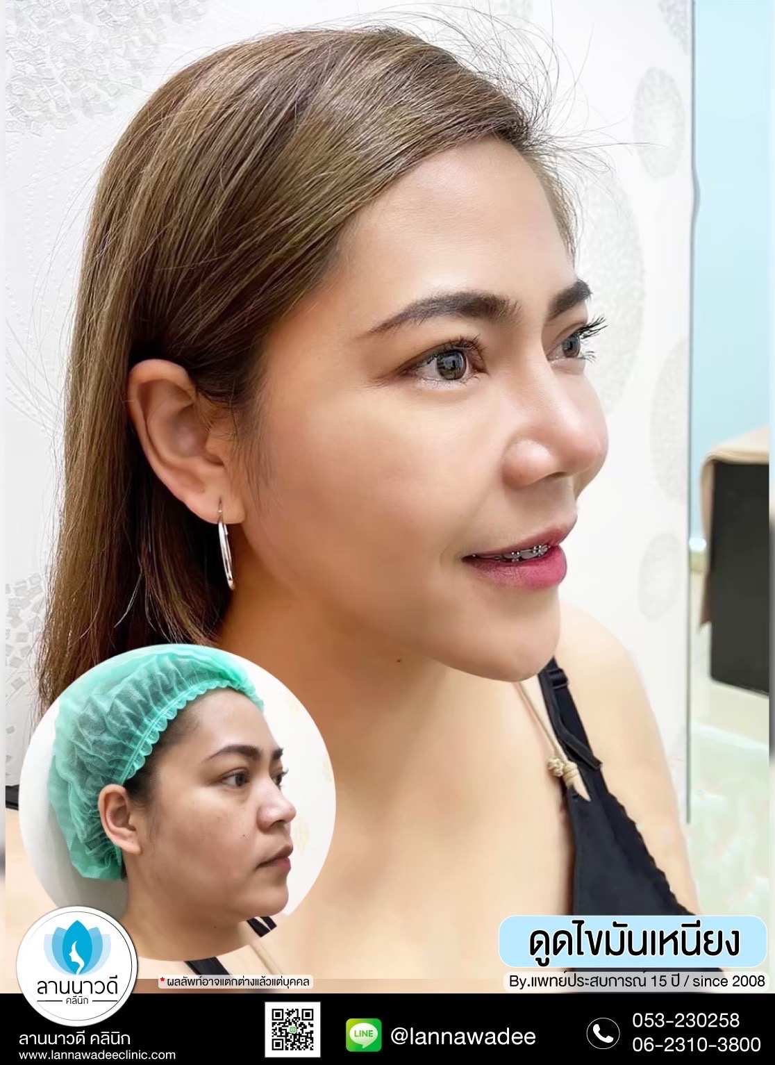 Liposuction of double chin Chiang Mai