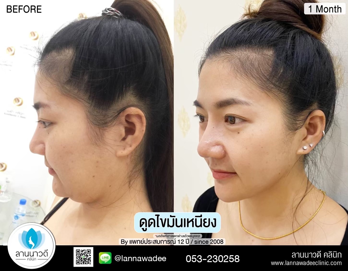 Liposuction of double chin Chiang Mai