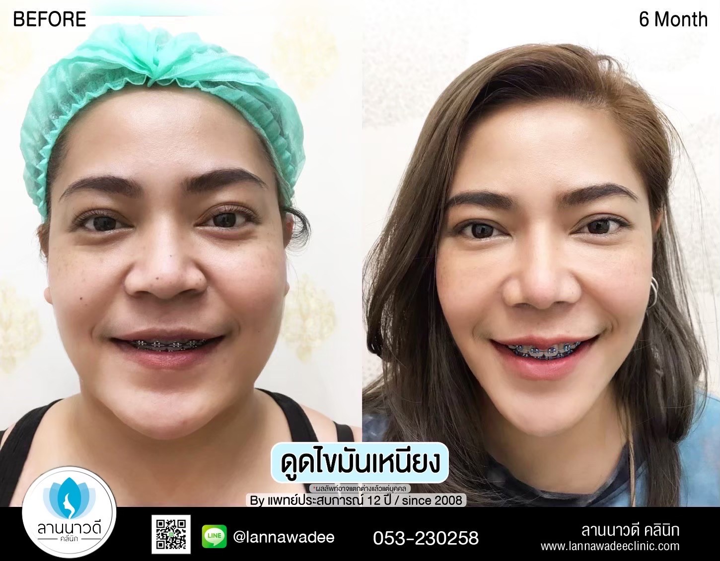 Liposuction of double chin Chiang Mai