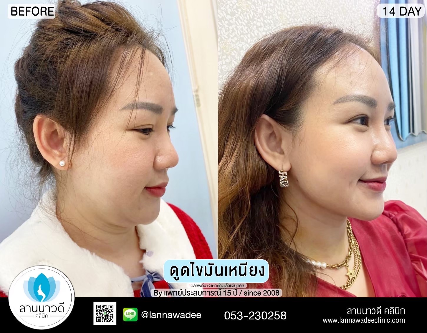 Liposuction of double chin Chiang Mai