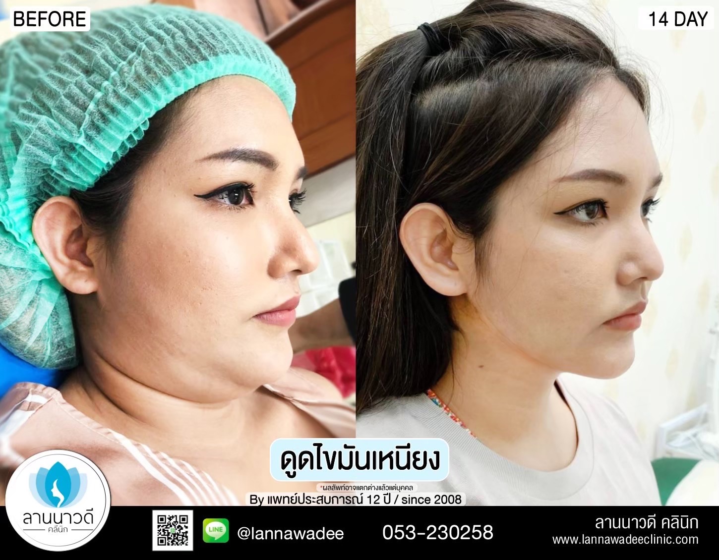 Liposuction of double chin Chiang Mai