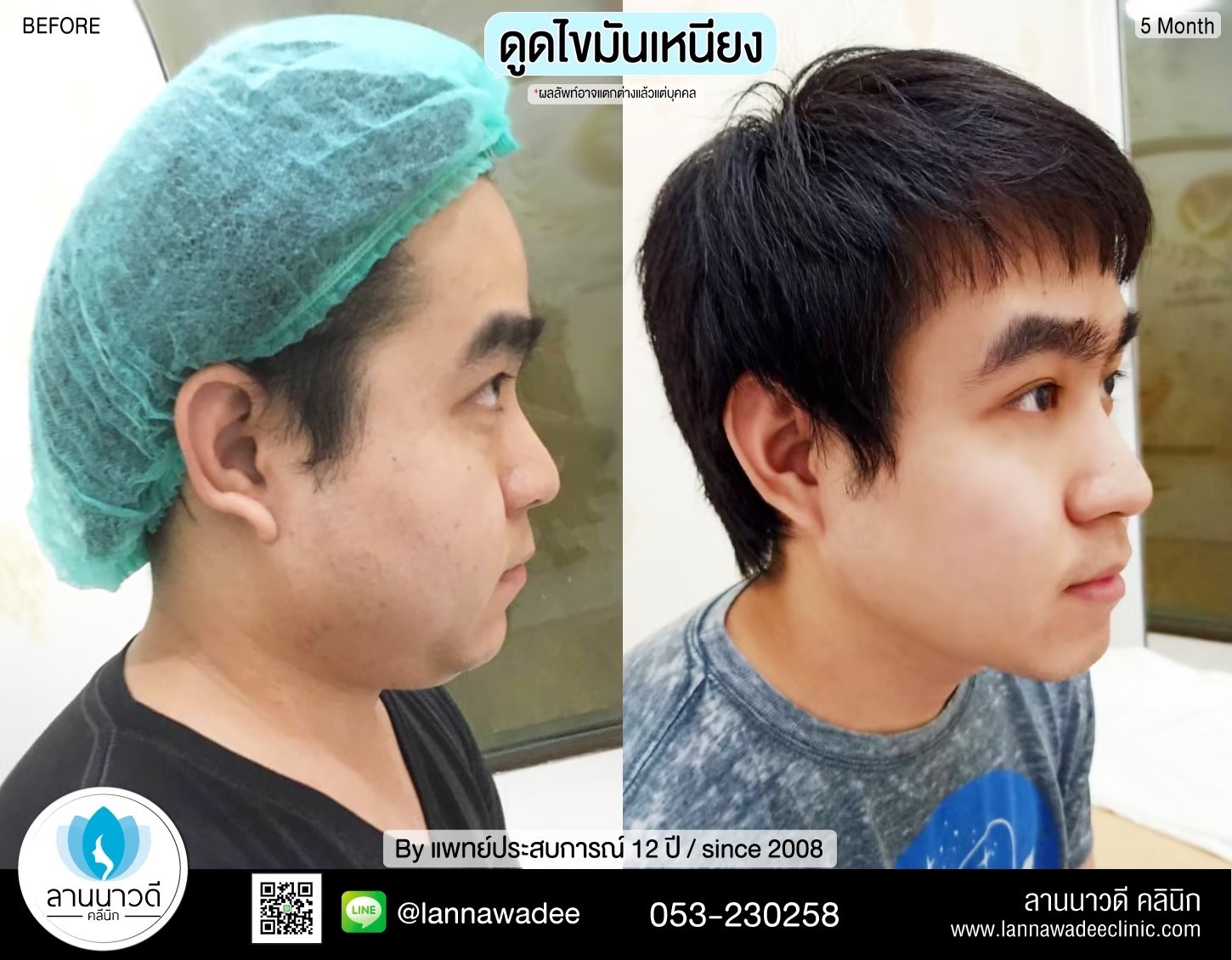 Liposuction of double chin Chiang Mai