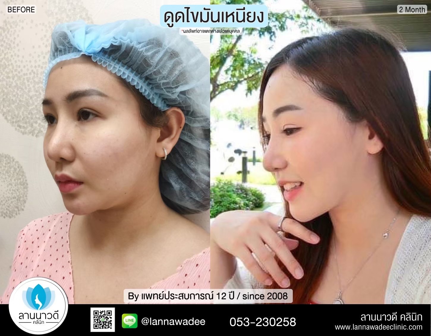 Liposuction of double chin Chiang Mai