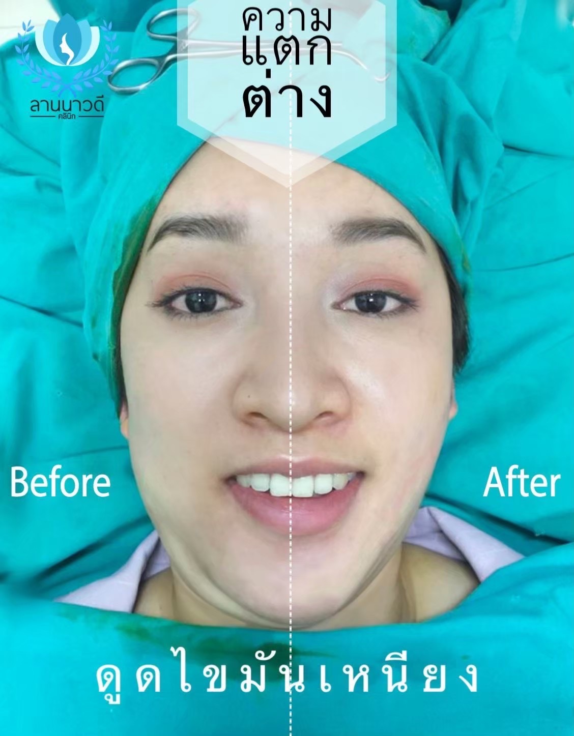 Liposuction of double chin Chiang Mai