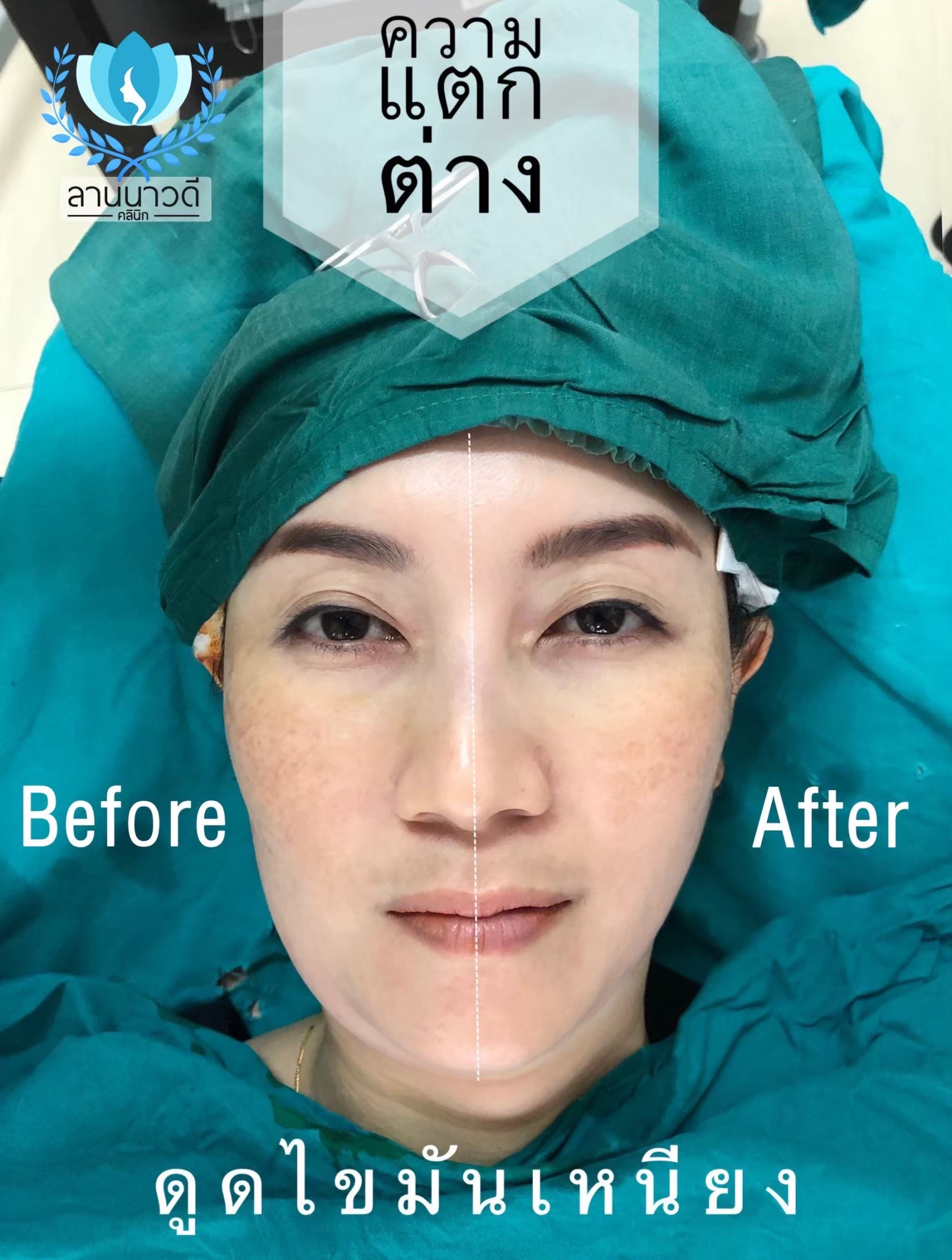 Liposuction of double chin Chiang Mai