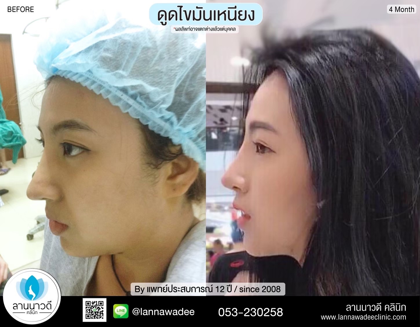 Liposuction of double chin Chiang Mai