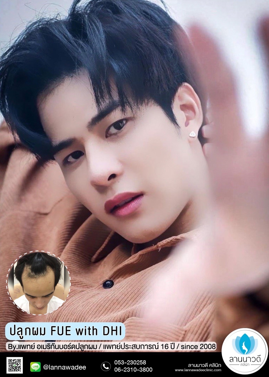 ปลูกผม