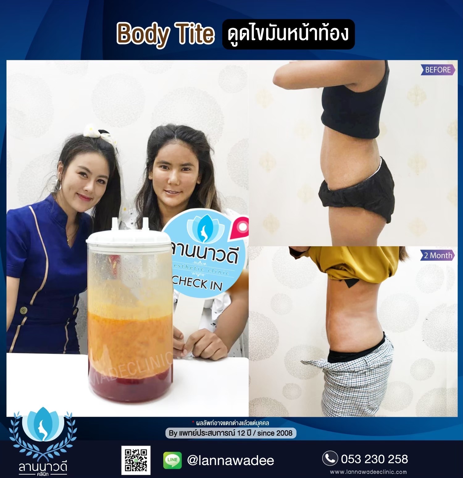 ลดไขมันเฉพาะจุด