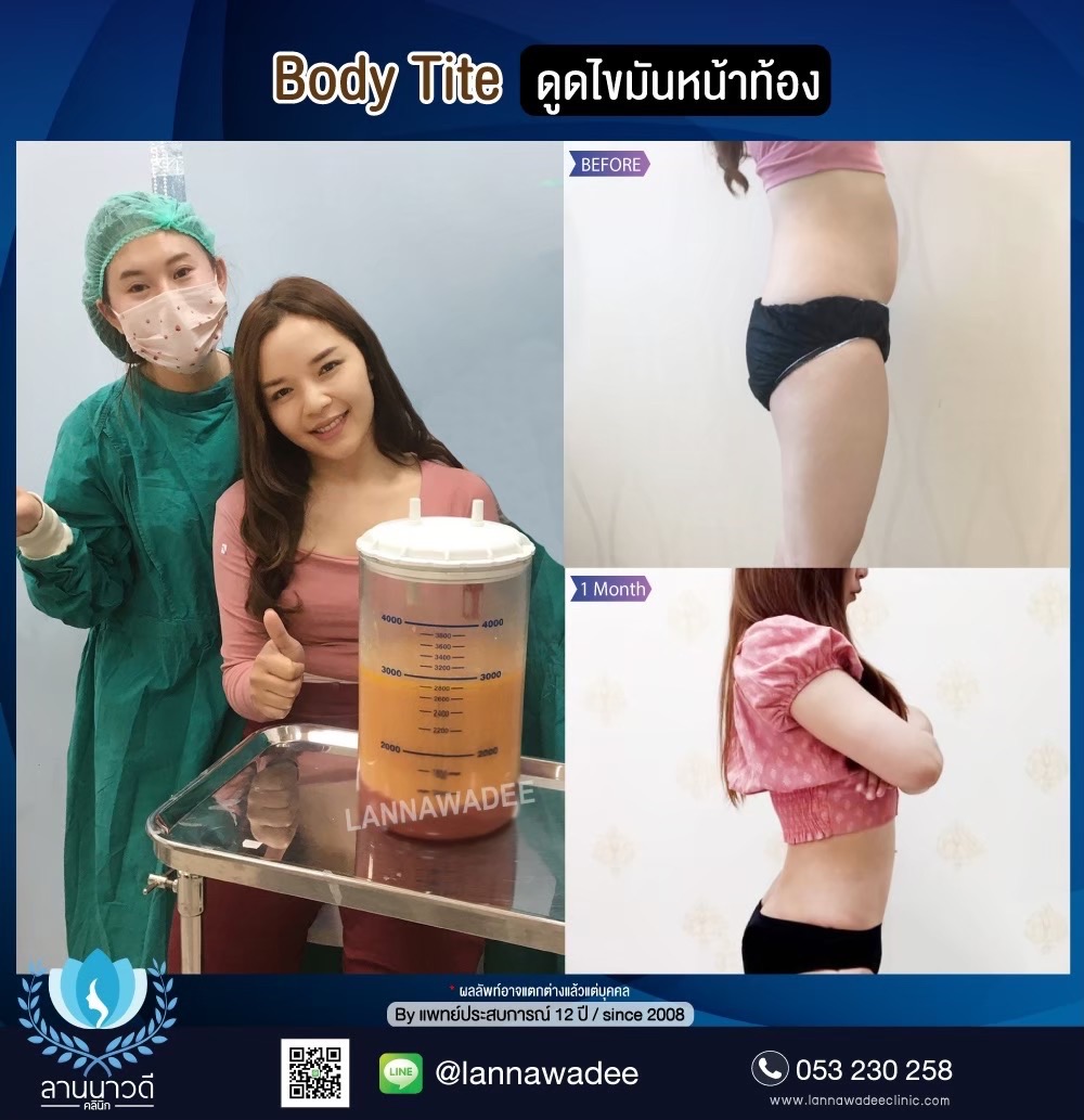 ลดไขมันเฉพาะจุด