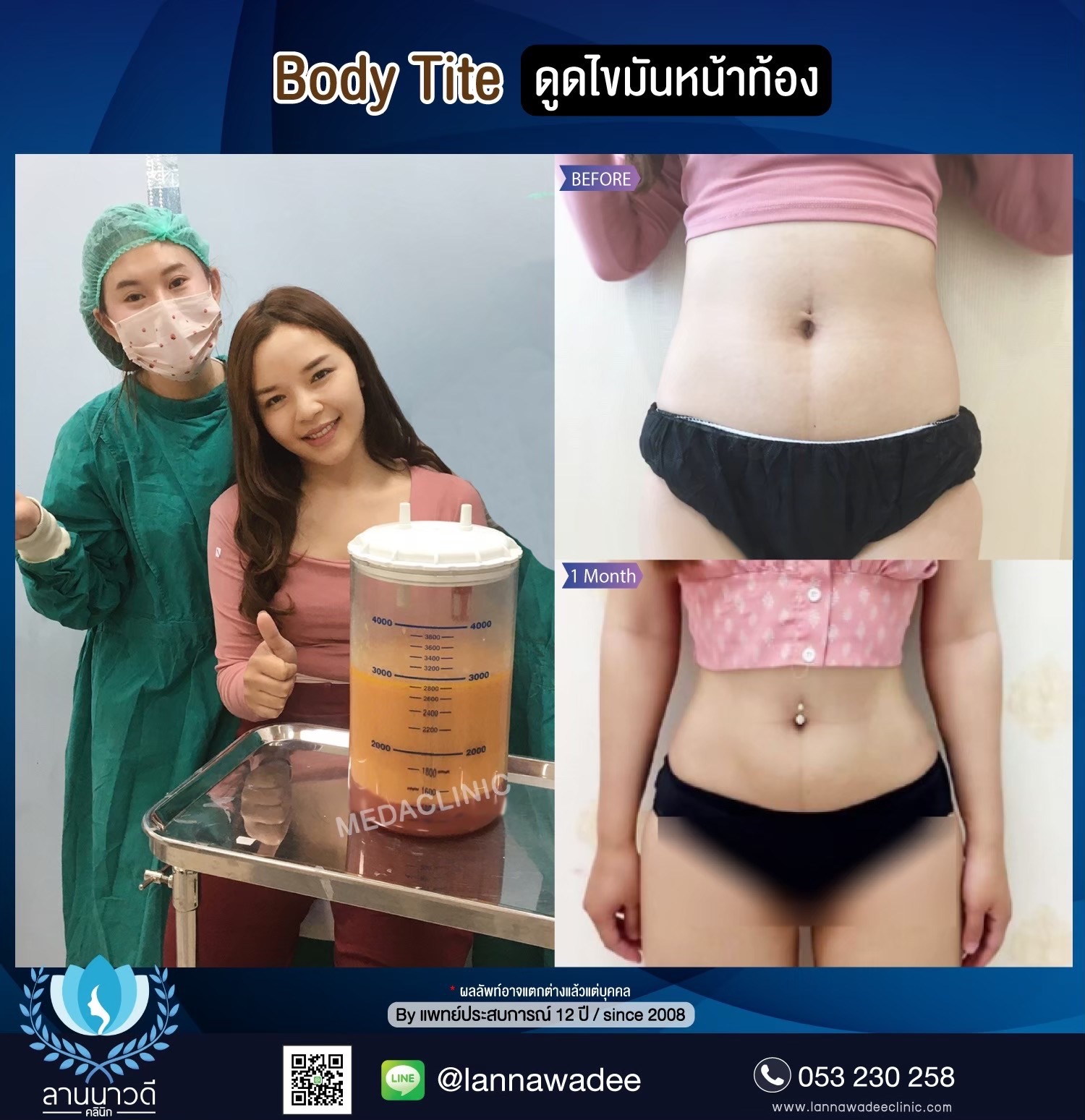 ลดไขมันเฉพาะจุด