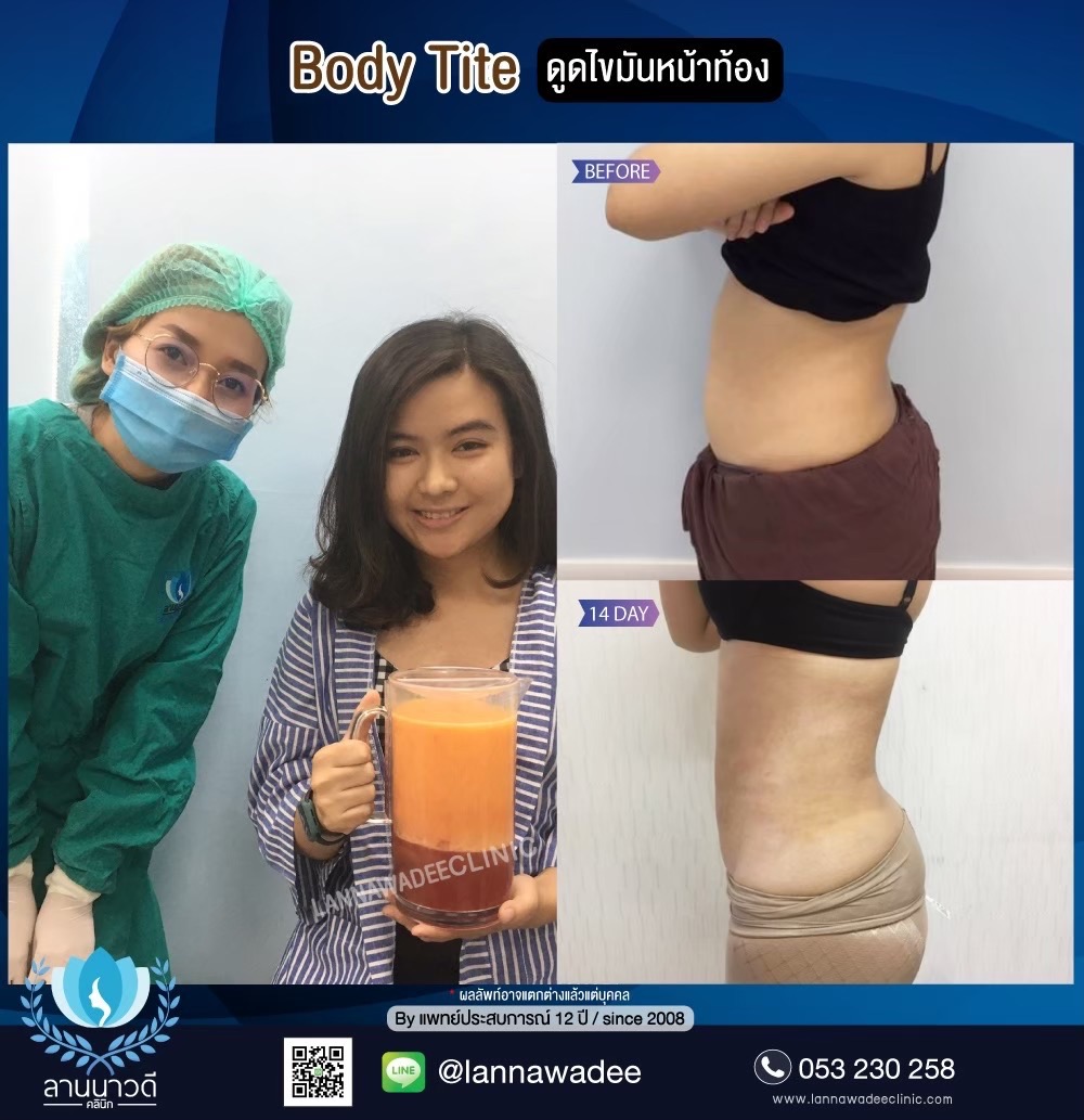 ลดไขมันเฉพาะจุด
