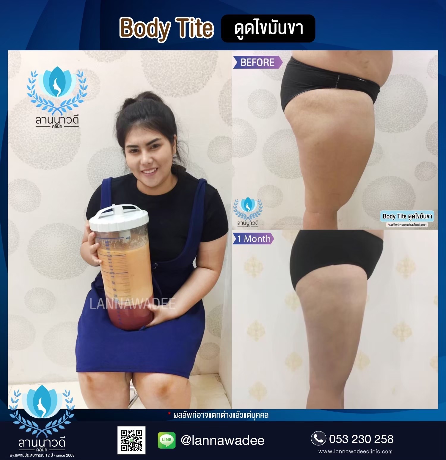 ลดไขมันเฉพาะจุด