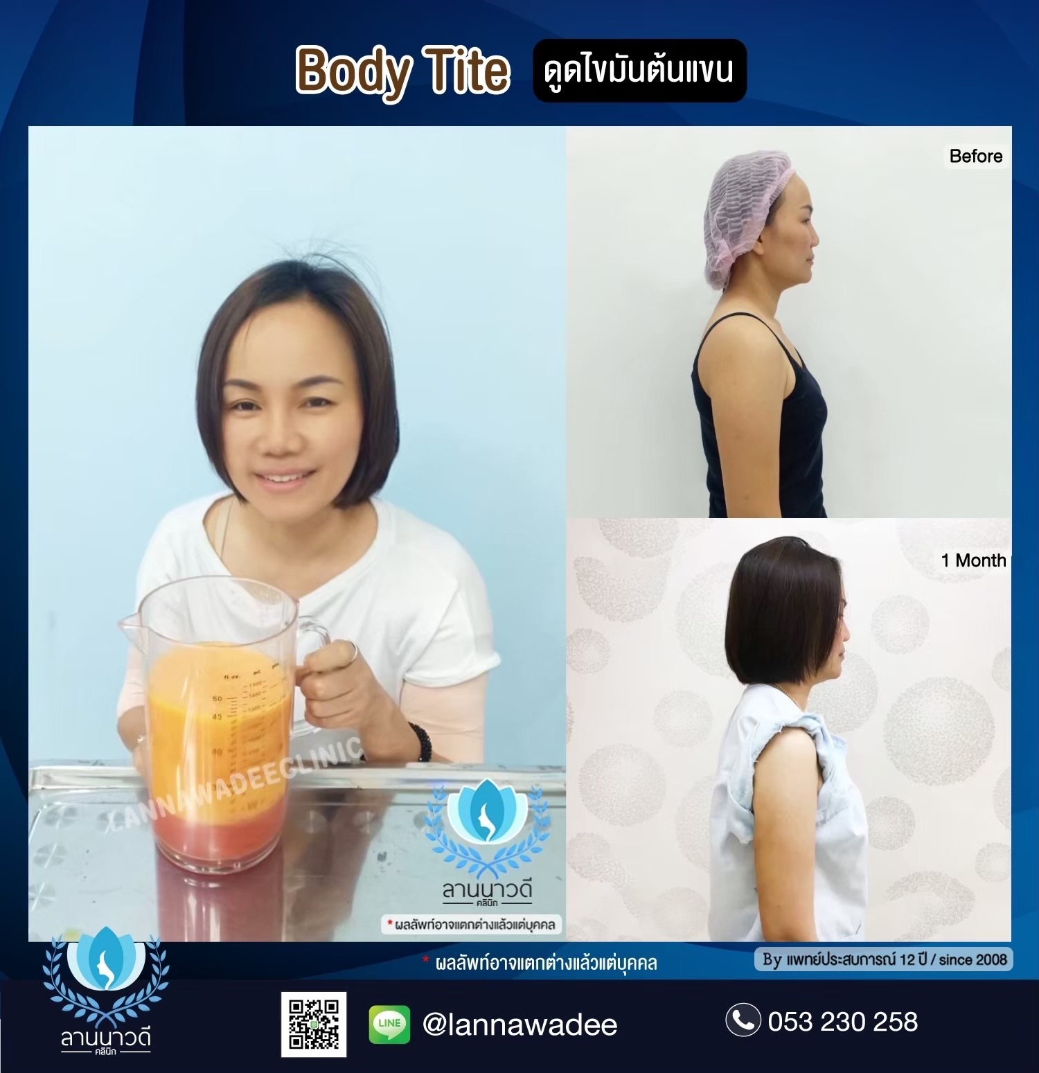 ลดไขมันเฉพาะจุด