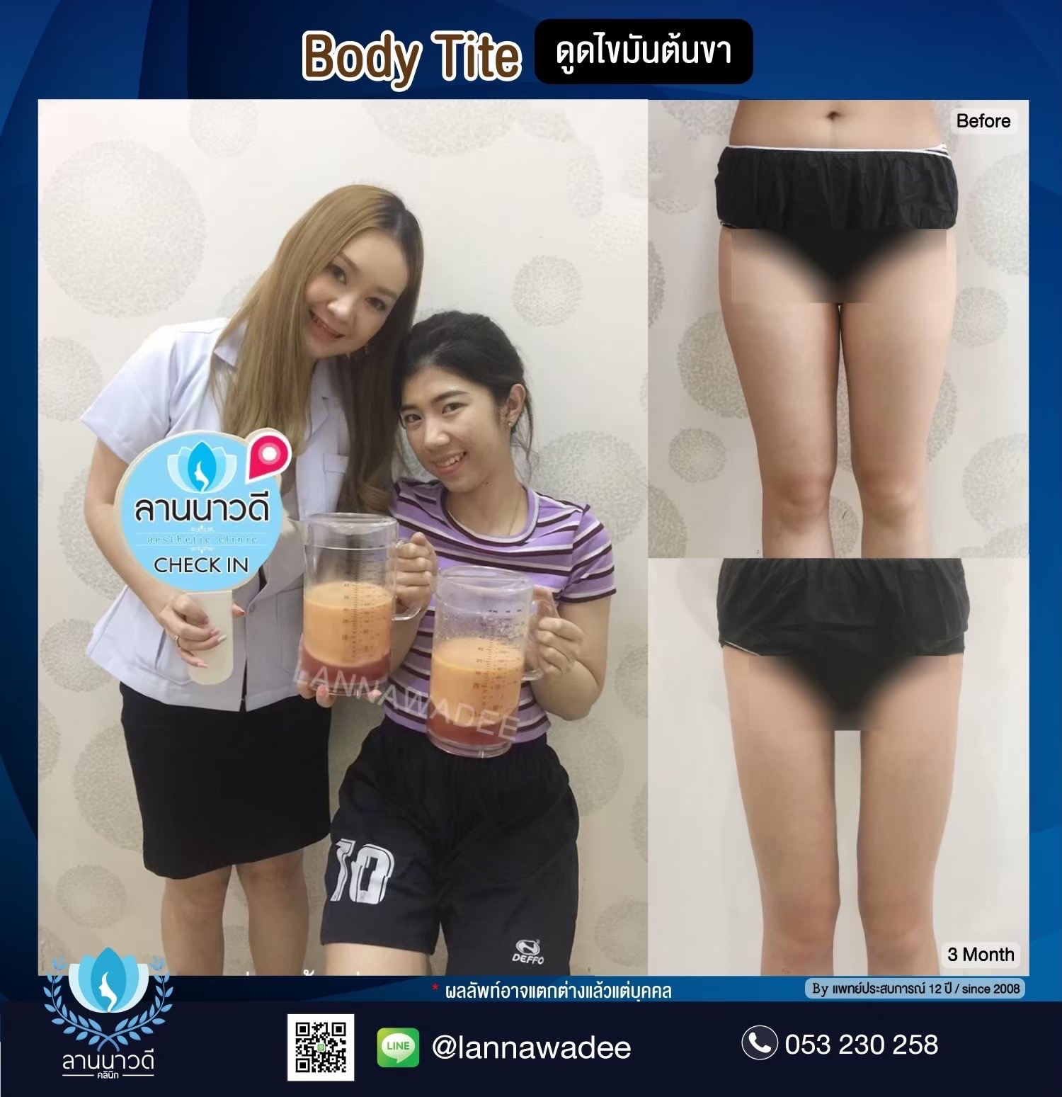 ลดไขมันเฉพาะจุด