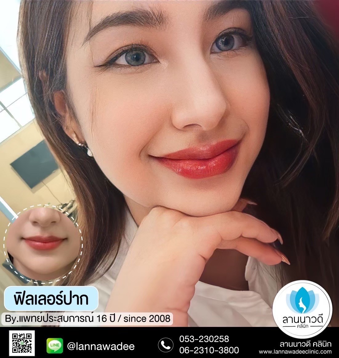ฟิลเลอร์ปากเชียงใหม่