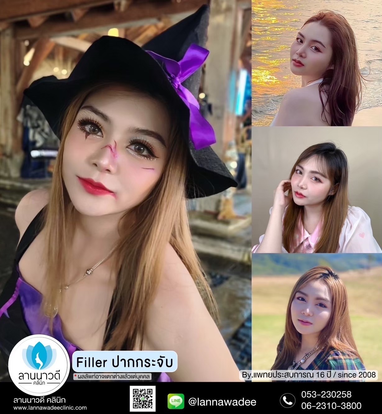 ฟิลเลอร์ปากเชียงใหม่