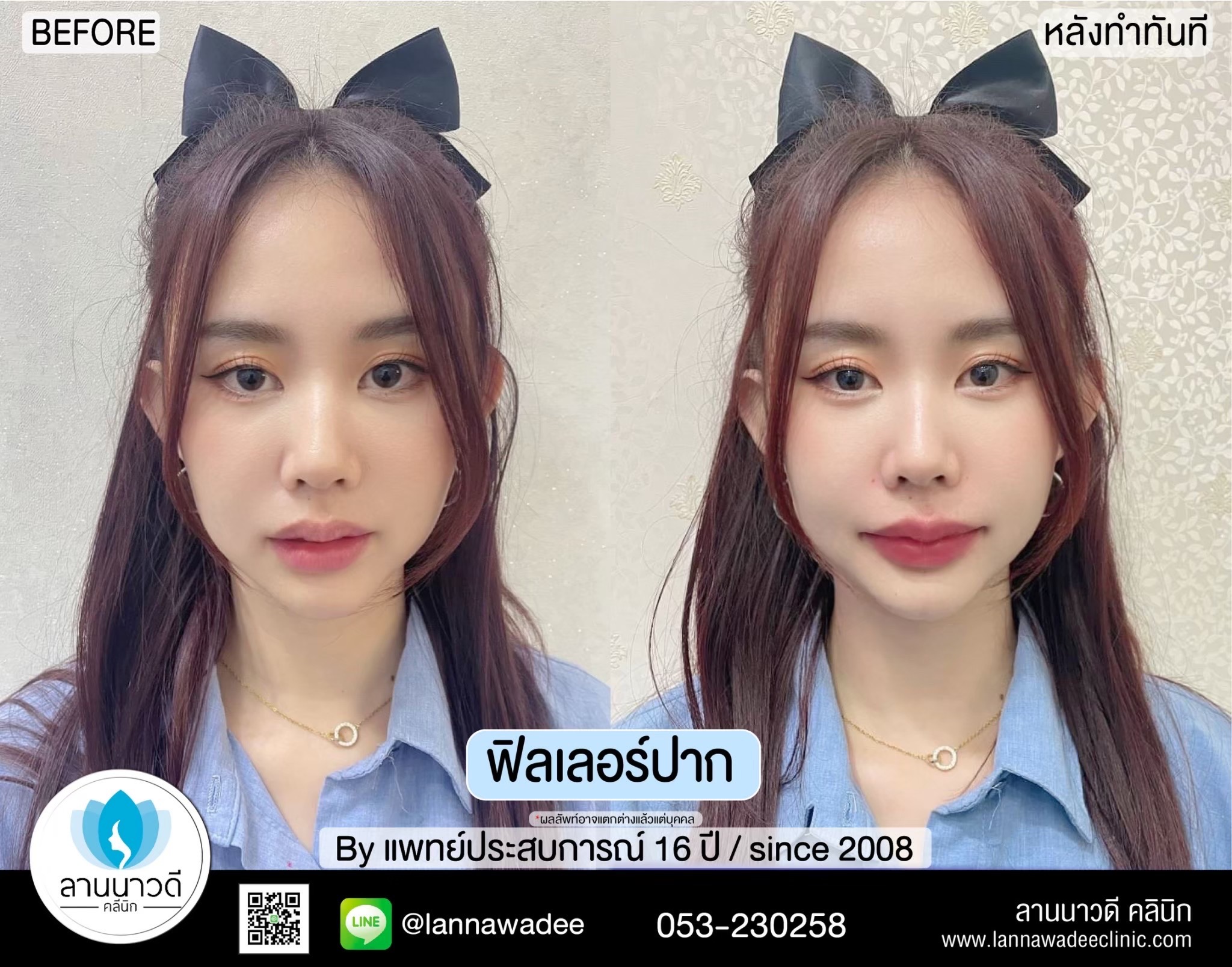 ฟิลเลอร์ปากเชียงใหม่