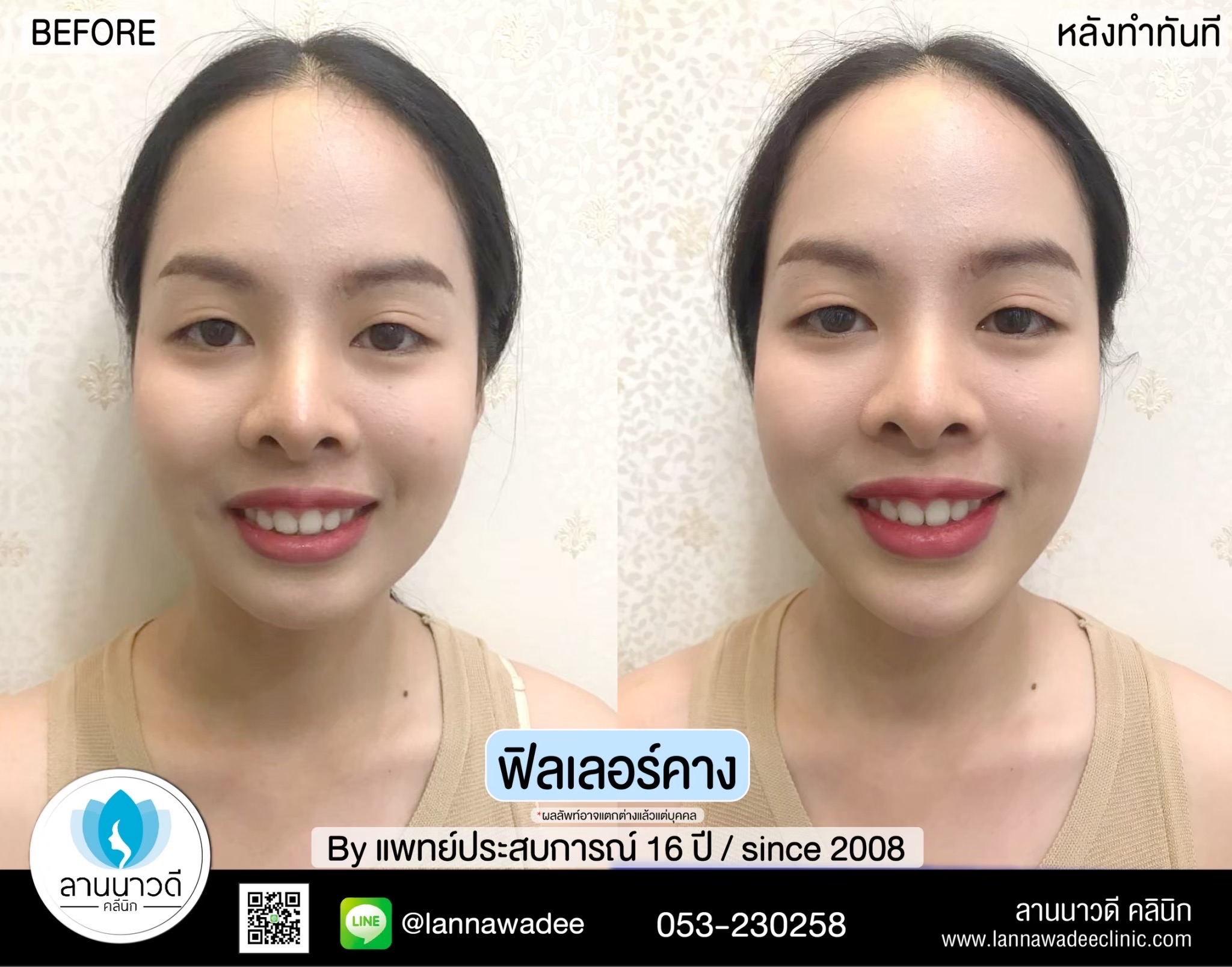ฟิลเลอร์ปากเชียงใหม่