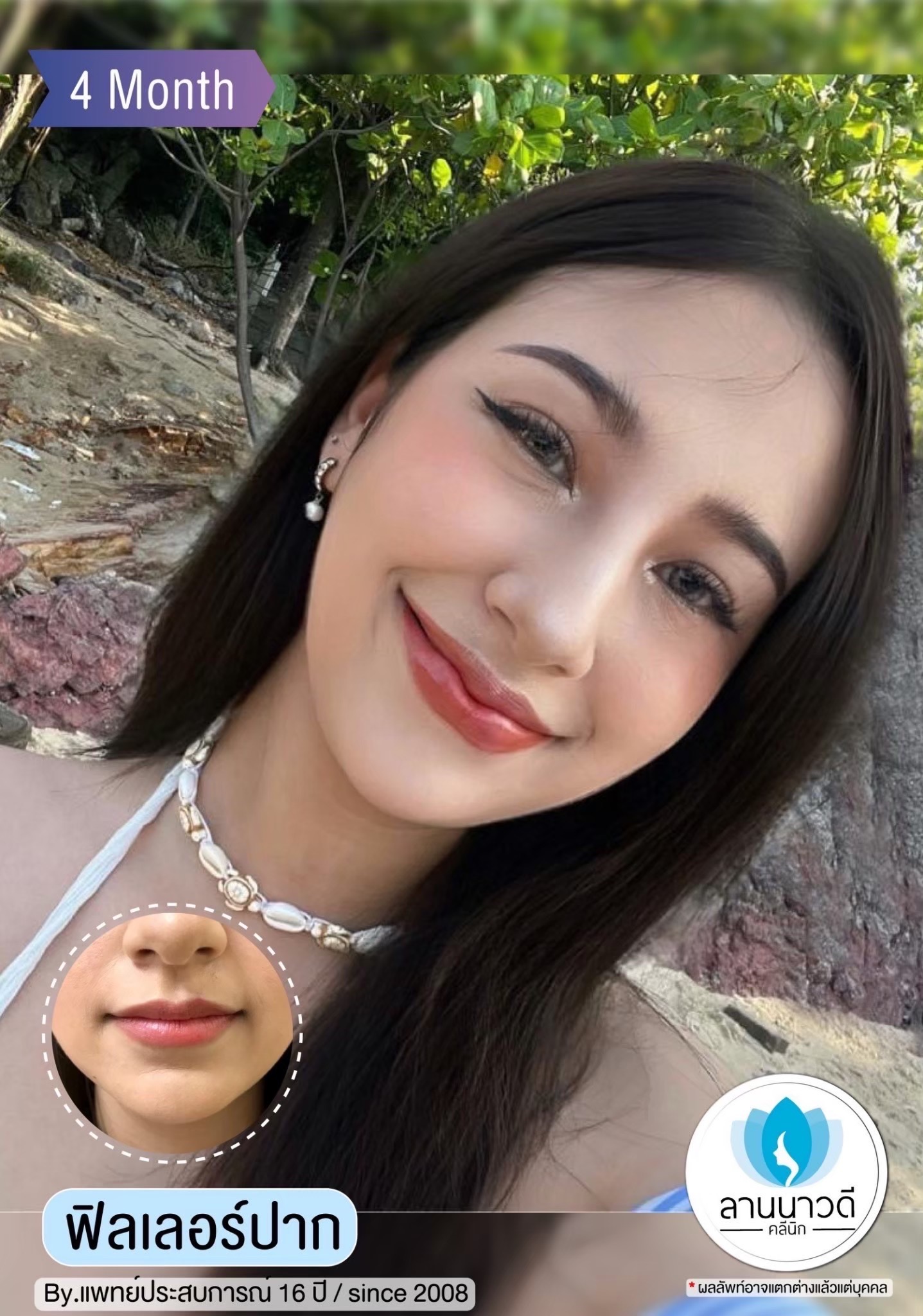 ฟิลเลอร์ปากเชียงใหม่