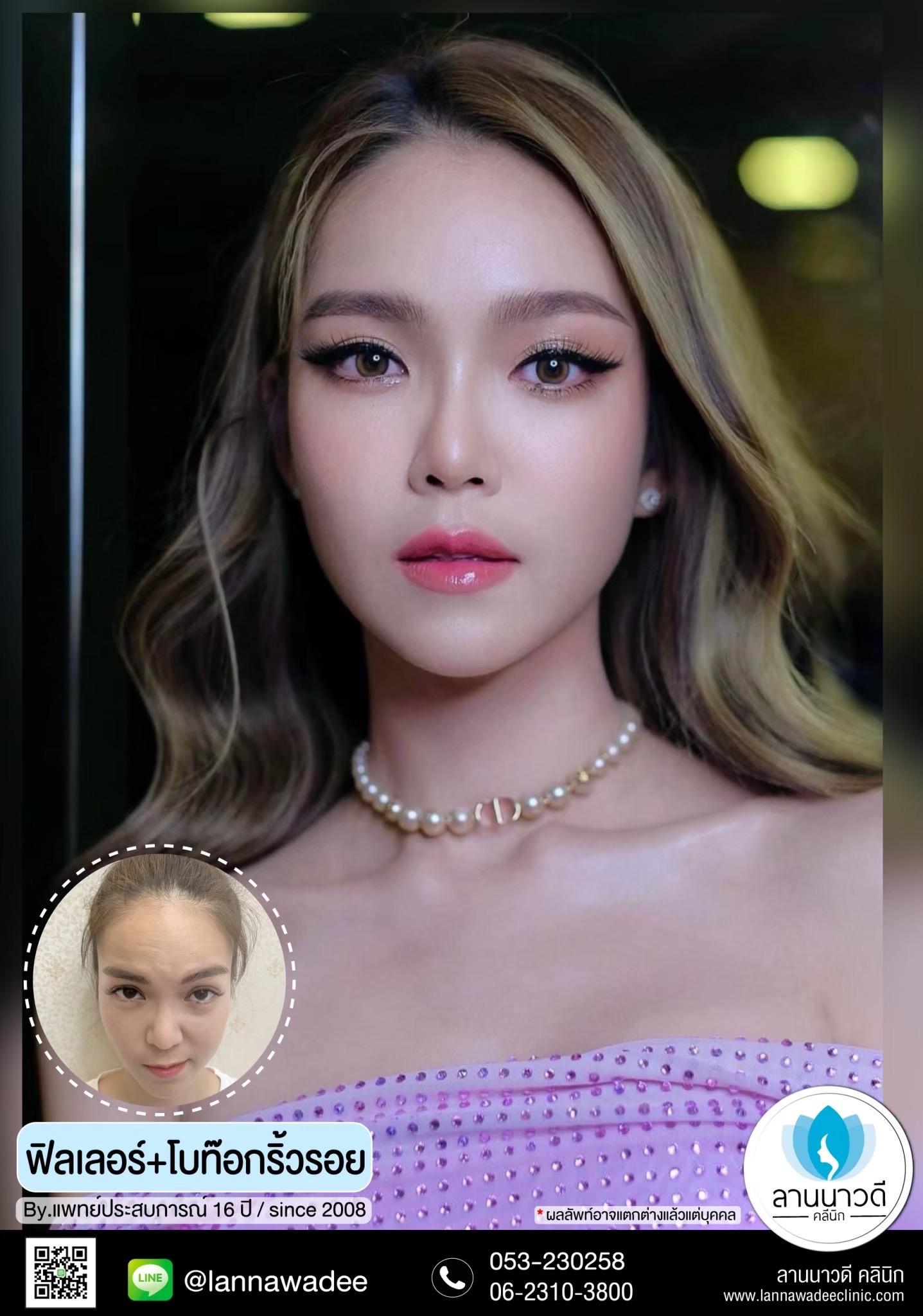 ฟิลเลอร์ปากเชียงใหม่