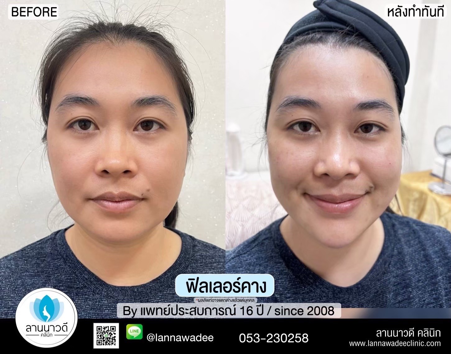 ฟิลเลอร์ปากเชียงใหม่