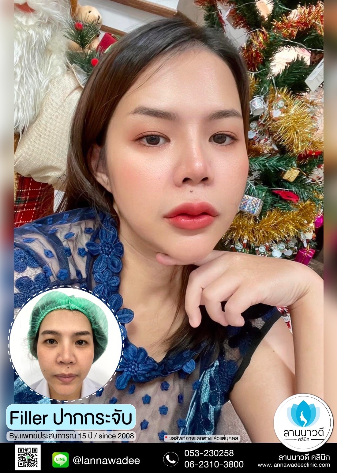 ฟิลเลอร์ปากเชียงใหม่