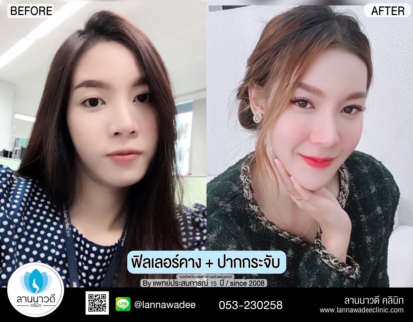 ฟิลเลอร์ปากเชียงใหม่